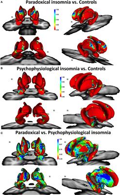 Alterations of Subcortical Brain Structures in Paradoxical and Psychophysiological Insomnia Disorder